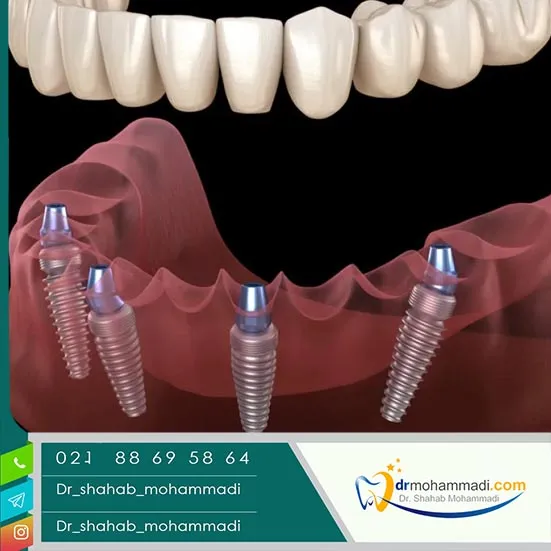 مدت زمان نصب روکش ایمپلنت: روکش ایمپلنت چقدر زمان میبرد؟